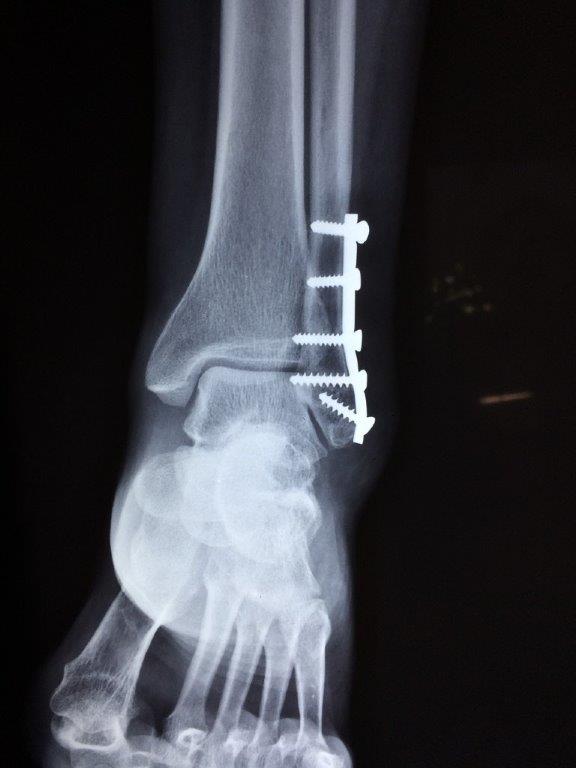 fratura- osteoporose-DR.Manuel Gonzáles Teyes- Pixabay